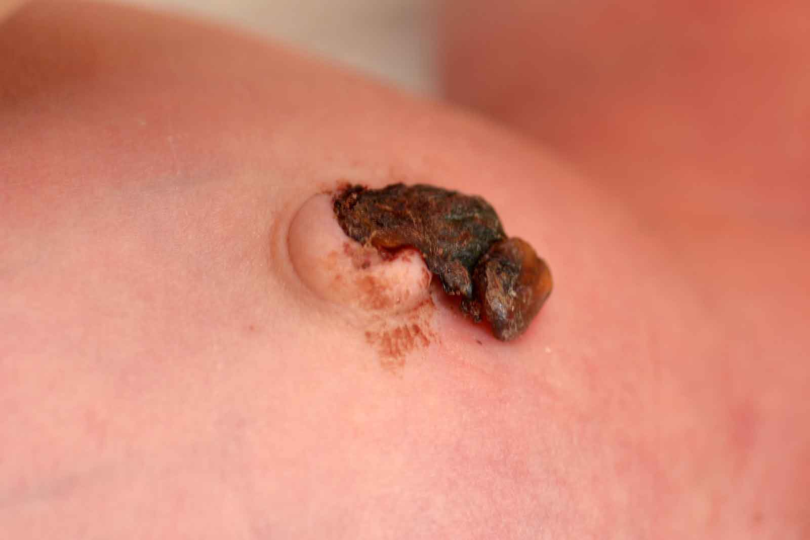 عکس عفونت بند ناف نوزاد | مرکز پارسیان مهرپرور