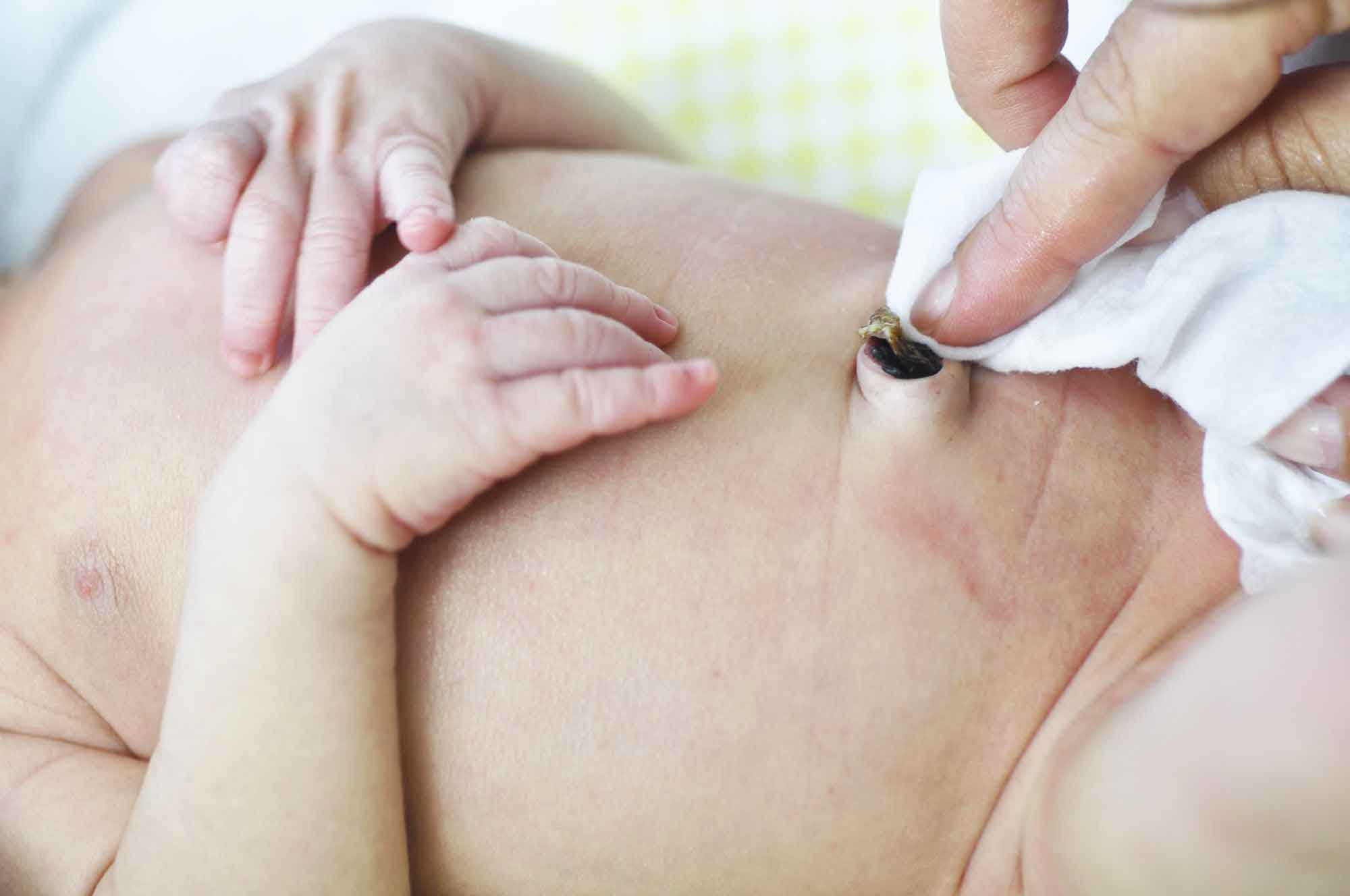 عفونت بند ناف نوزادان | مرکز پارسیان مهرپرور