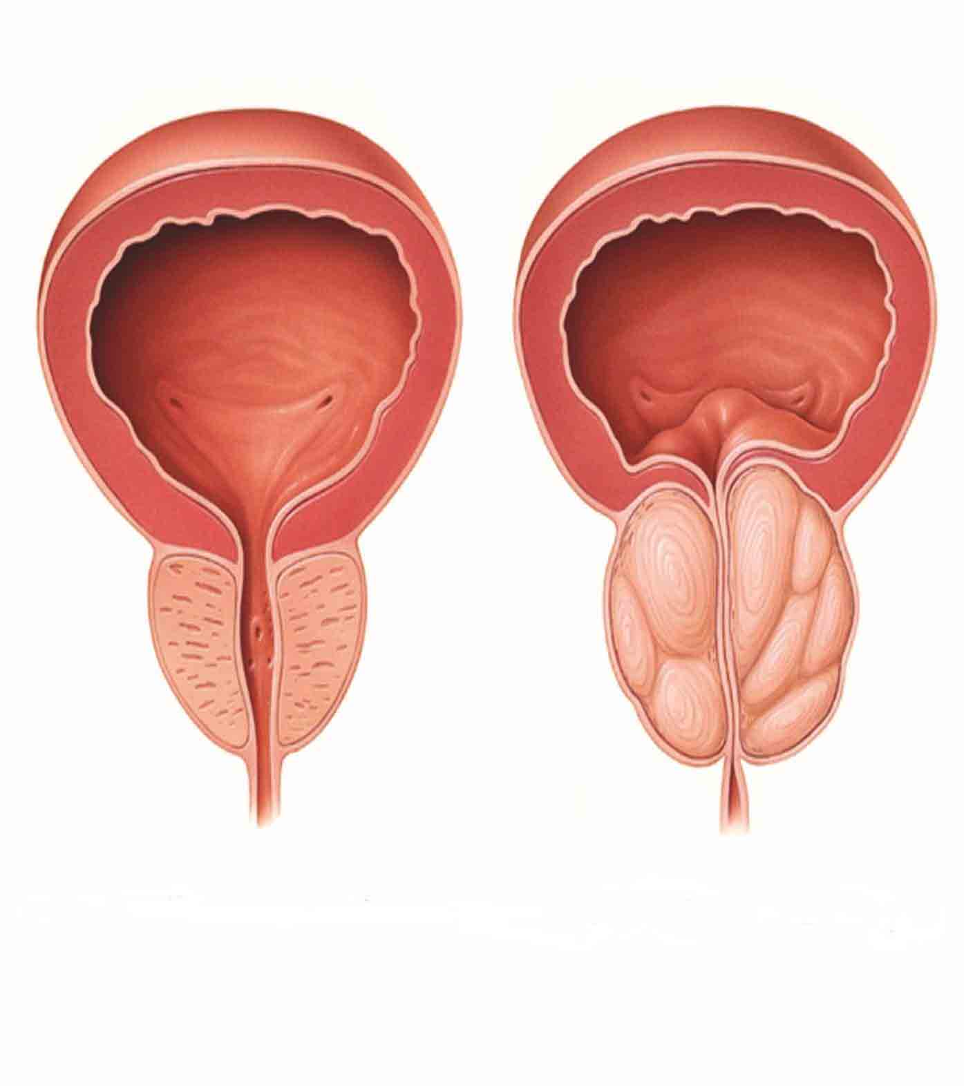 پروستات در سالمندان |مرکز پارسیان مهرپرور