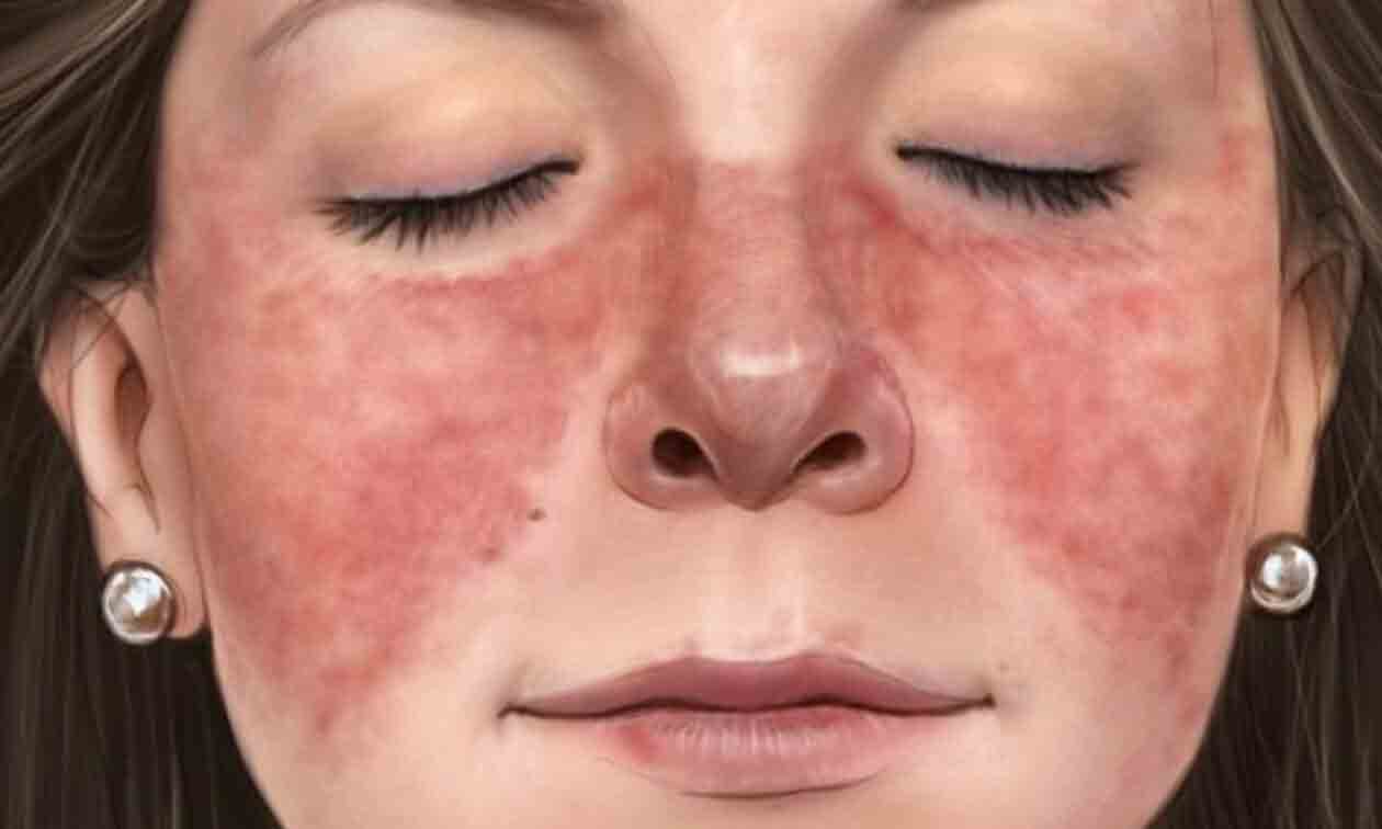 بیماری لوپوس پوستی | مرکز خدمات پرستاری پارسیان مهرپرور