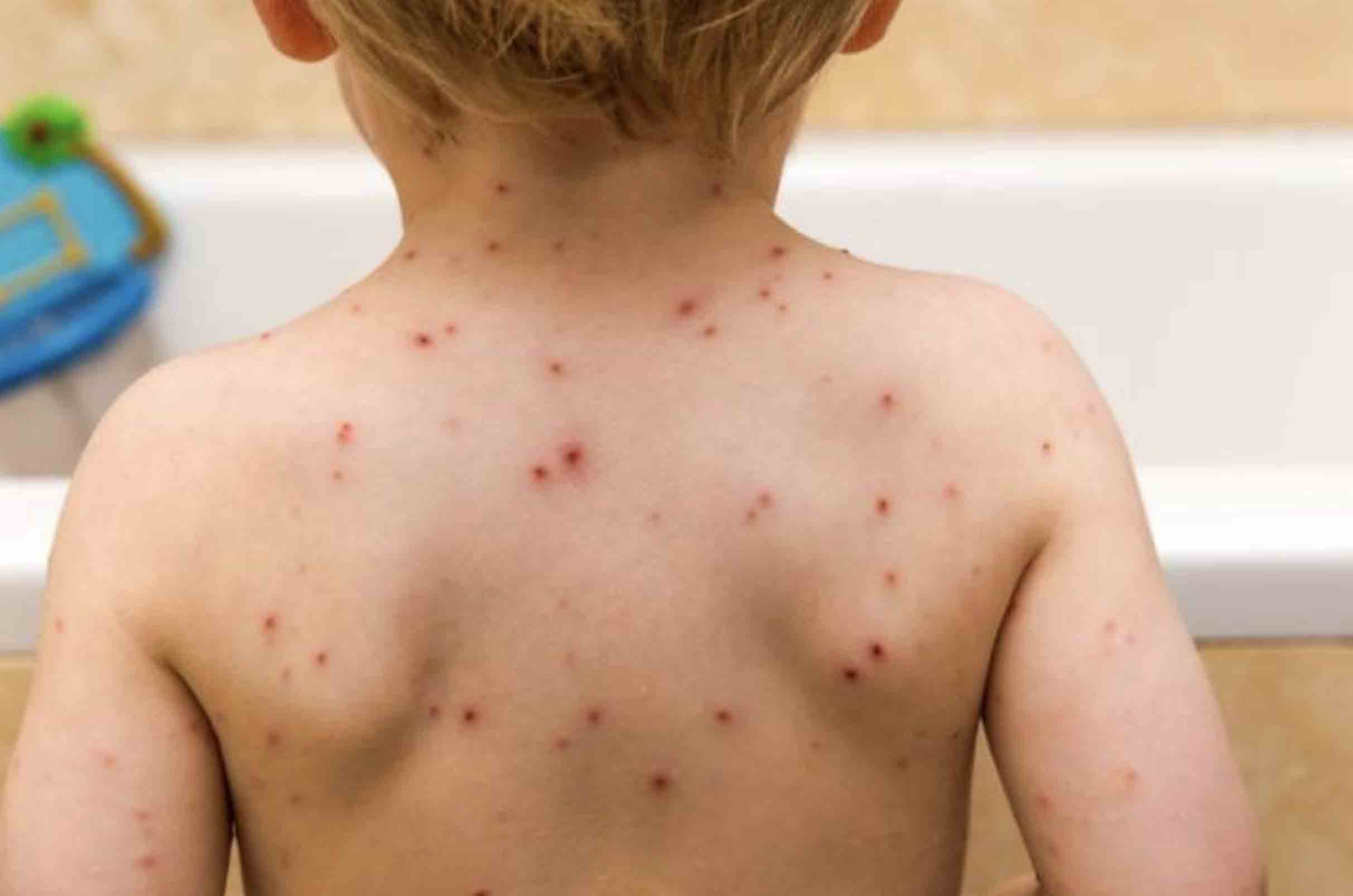 علائم مننژیت | مرکز خدمات پرستاری مهرپرور