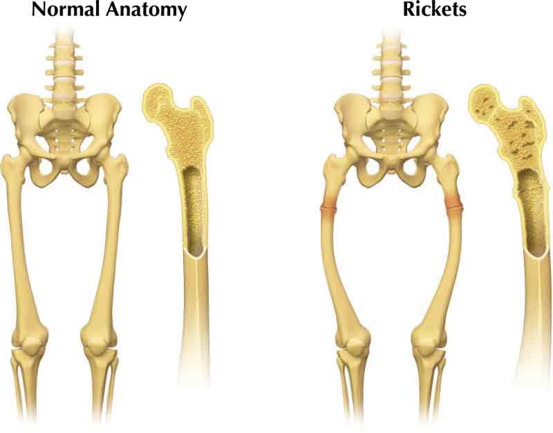 عکس نرمی استخوان در کودکان | مرکز خدمات پرستاری پارسیان مهرپرور 