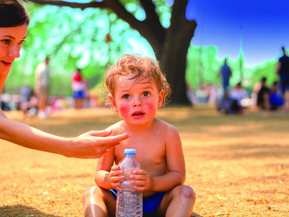گرمازدگی کوذکان | مرکز پارسیان مهرپرور