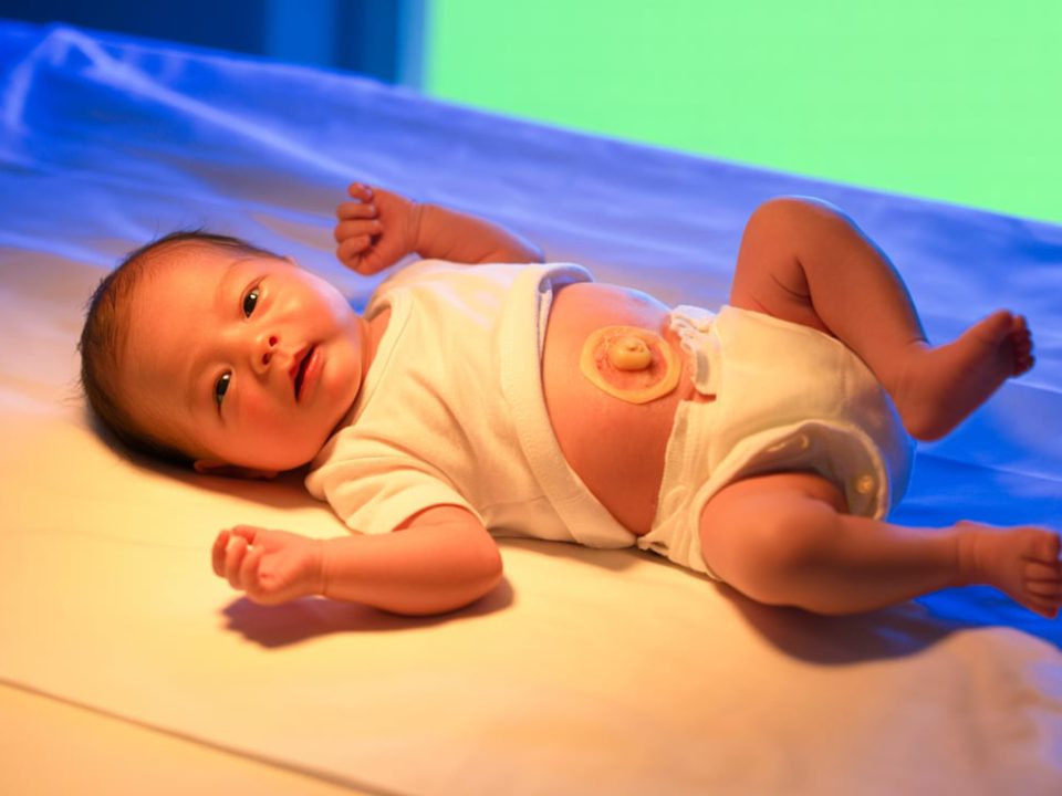 فتق ناف در نوزادان | مرکز خدمات پرستاری مهرپرور